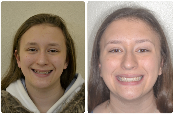 Before and After Orthodontic Treatment